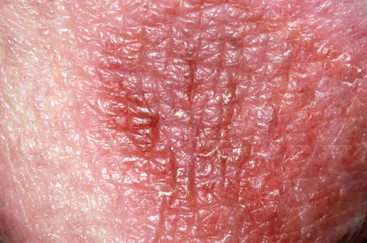 Rash on Penis Head: Causes, Symptoms, and Treatments